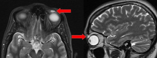 Forrás: BMJ Case Reports 2018
